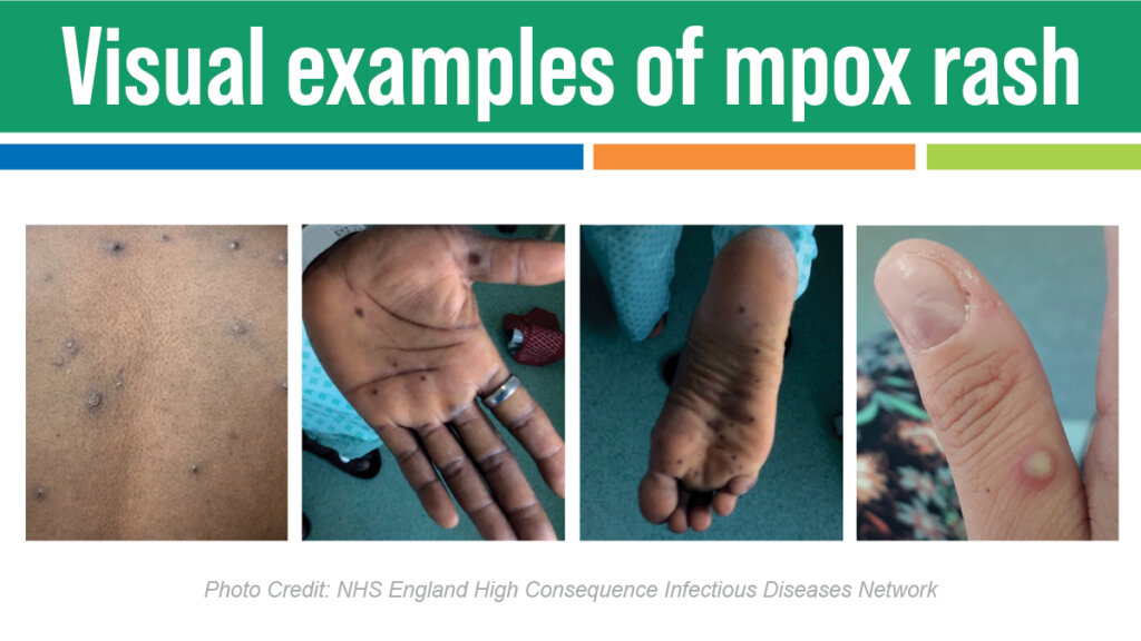 mpox