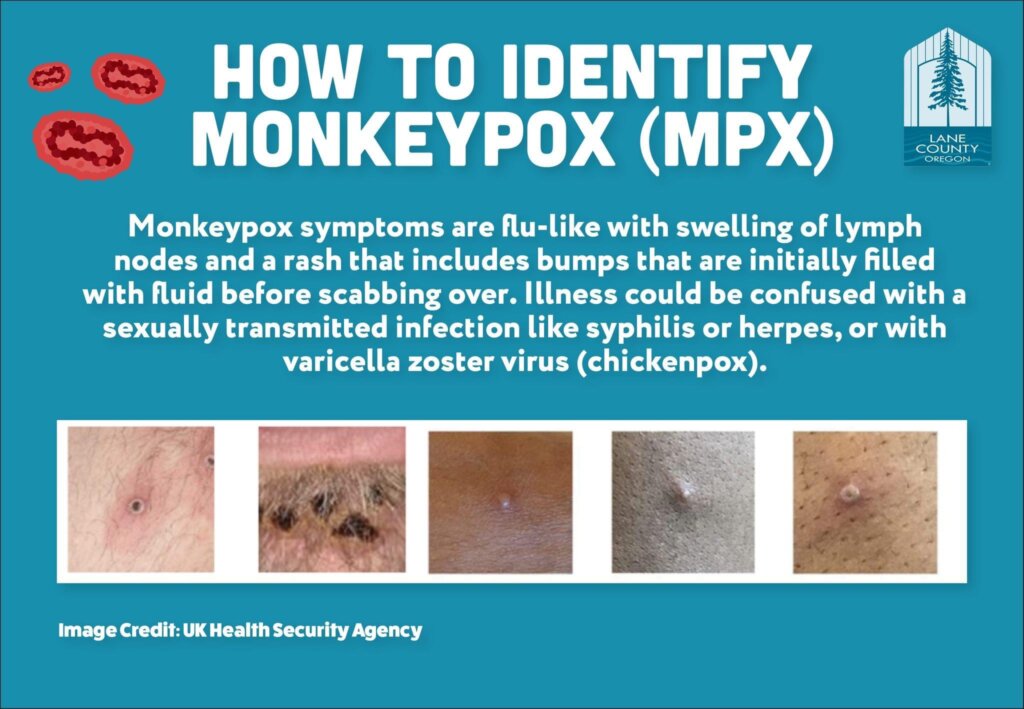 how to identify Mpox