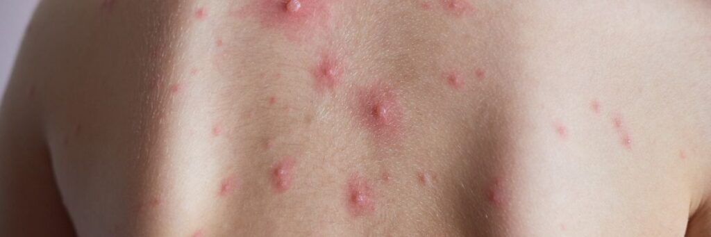 A close-up image showing mpox-related skin rashes and lesions on the back, used for illustrating mpox diet tips and health guidance.